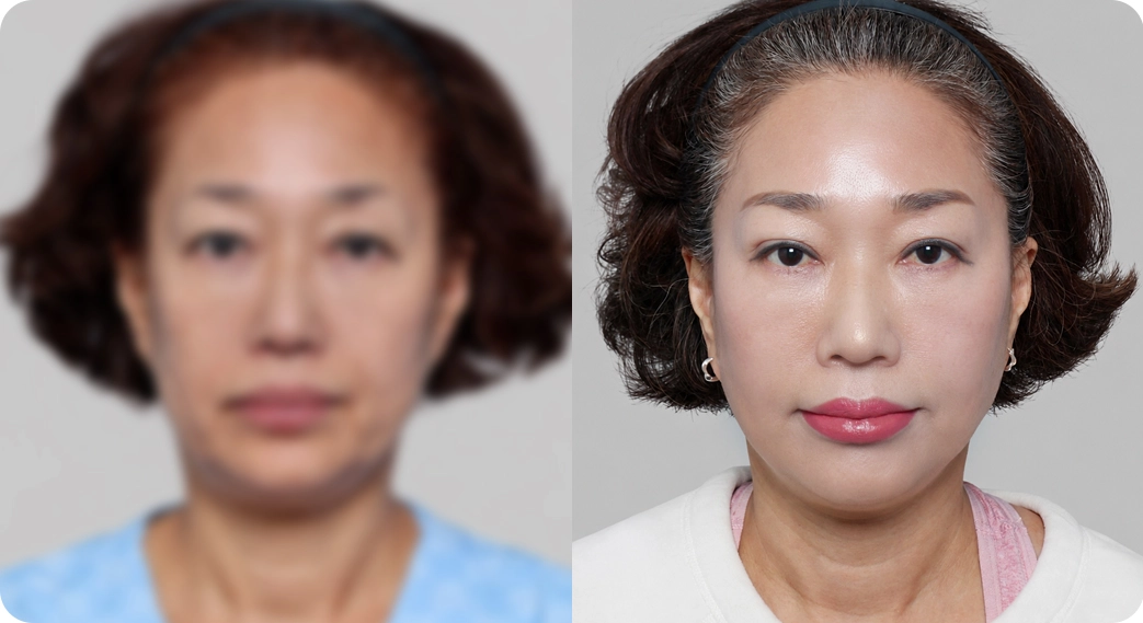나나리프팅센터 전후사진 1