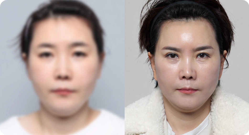 나나리프팅센터 전후사진 2