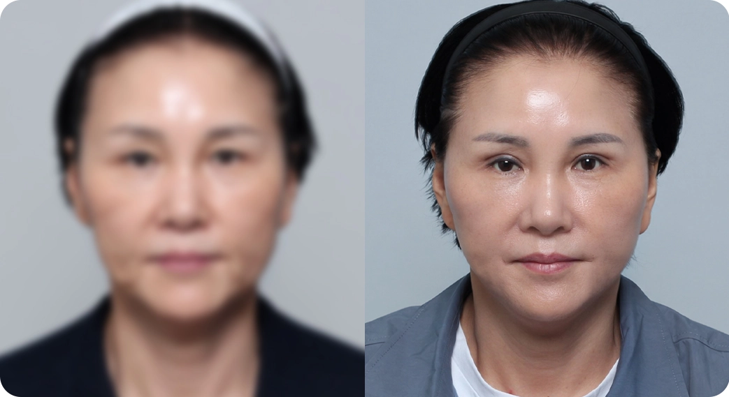 나나리프팅센터 전후사진 3