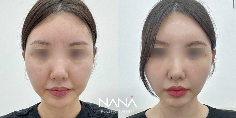 얼굴지방이식 전후 사진