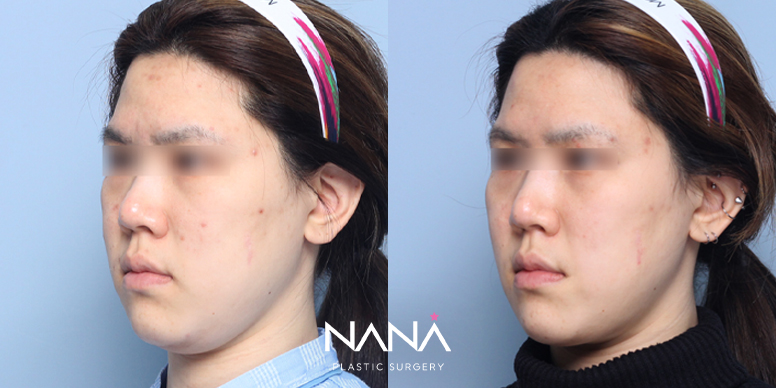 얼굴지방흡입 전후 사진