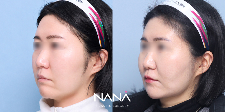 얼굴지방흡입 전후 사진