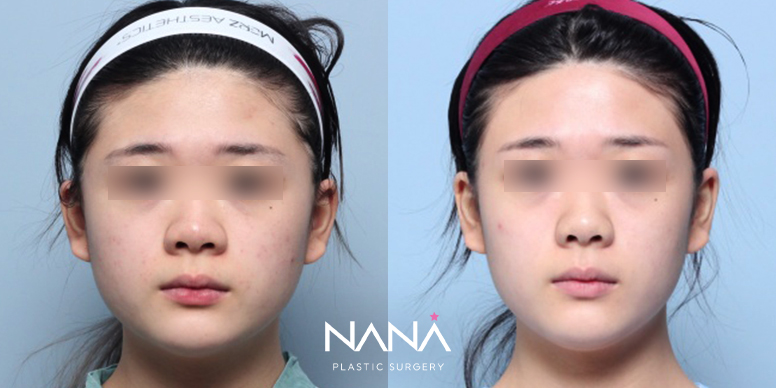 이마축소 전후 사진