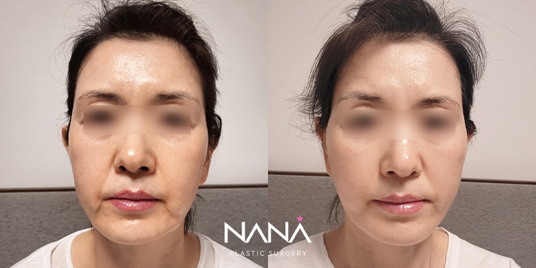중안면거상 전후 사진