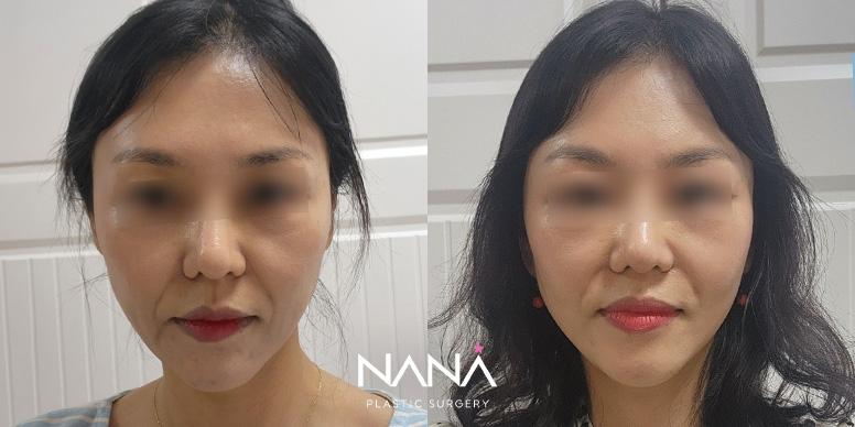 중안면거상 전후 사진