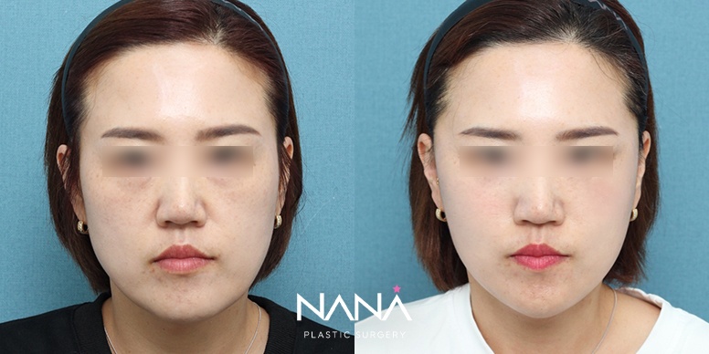 포니테일 리프팅 전후 사진