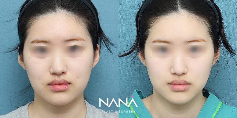포니테일 리프팅 전후 사진