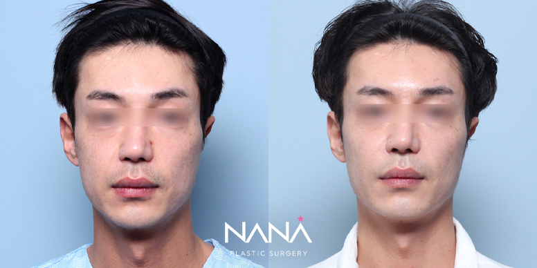 실리프팅 전후 사진