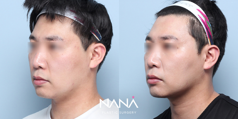 실리프팅 전후 사진