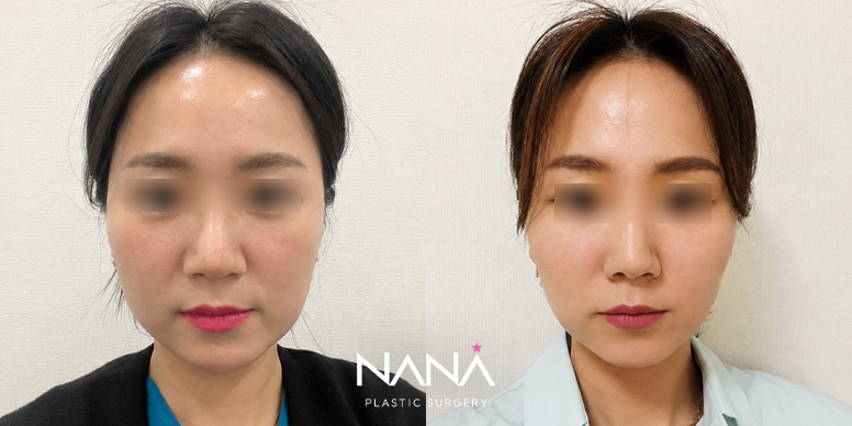 실리프팅 전후 사진