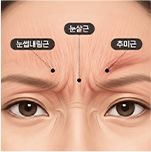 내시경을 사용한 정교한 박리