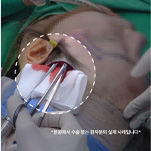 오래 가는 결과를 위한 넓은 박리