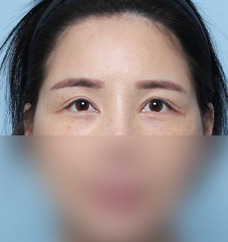 수술 전