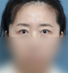 수술 후