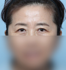 수술 전