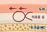 본터널링 고정 원리