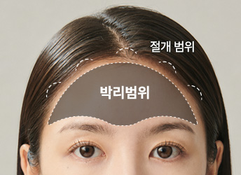 본터널링 고정력 및 범위