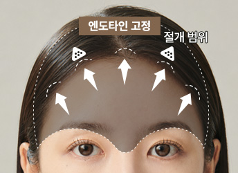 엔도타인 고정력 및 범위