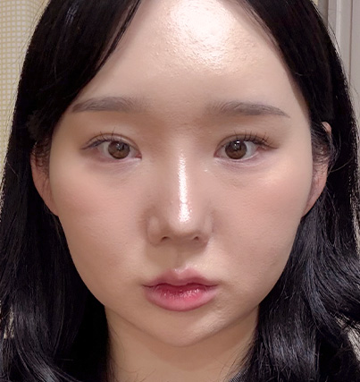 수술 전