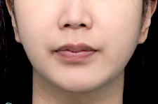 수술 후