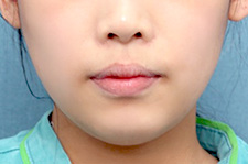수술 후