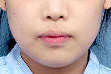 수술 전