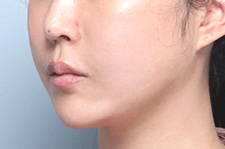 수술 후