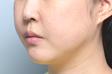 수술 전
