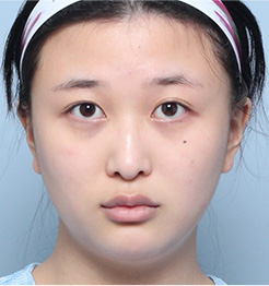 BEFORE 정면