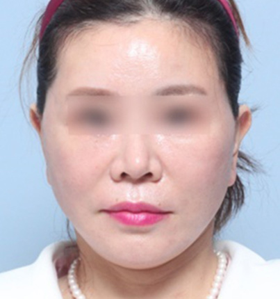 수술 후