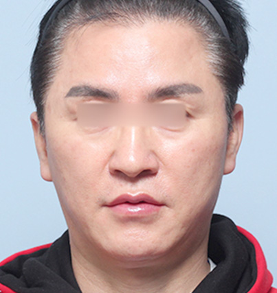 수술 전