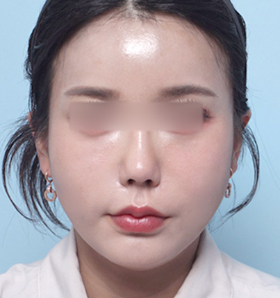 수술 후