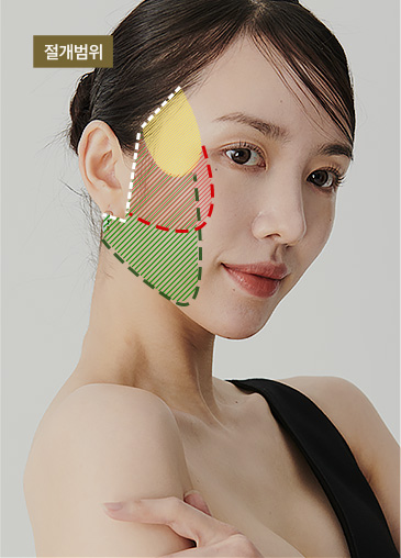 나나의 맞춤형 안면거상 절개범위