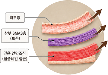 하이-SMAS 방식 도식