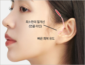 이주(Tragus) 절개 도식
