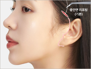 귓불(Lobule) 절개 도식
