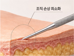 섬세한 박리