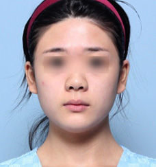수술 후