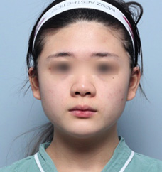 수술 전