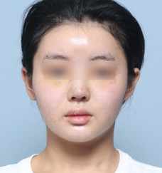 수술 후