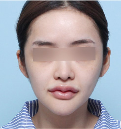 BEFORE 정면