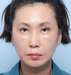 수술 후