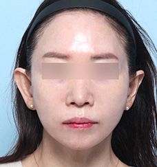 수술 후