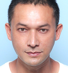 수술 후