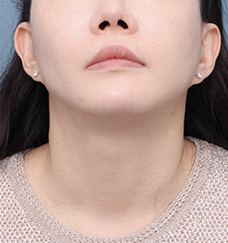 수술 후