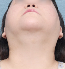 수술 후