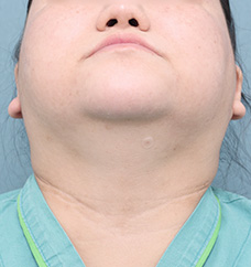 수술 전