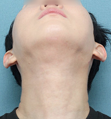 수술 후
