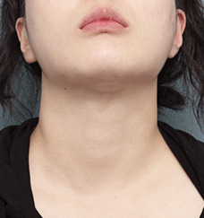 수술 후