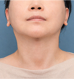 AFTER 정면